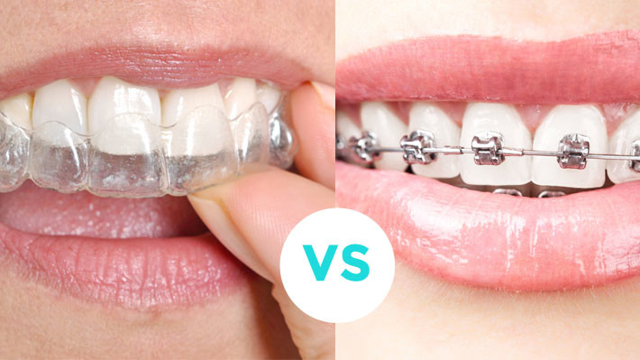 invisalign-vs-traditional-braces